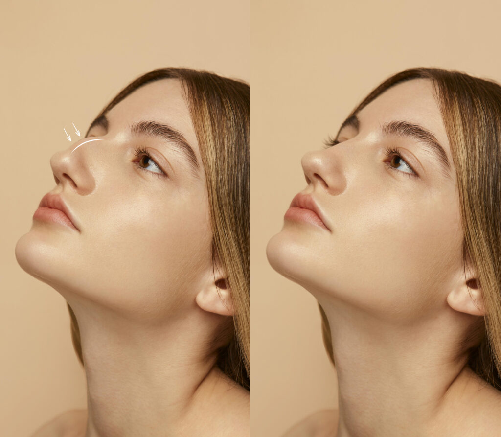 Retinol Before and After